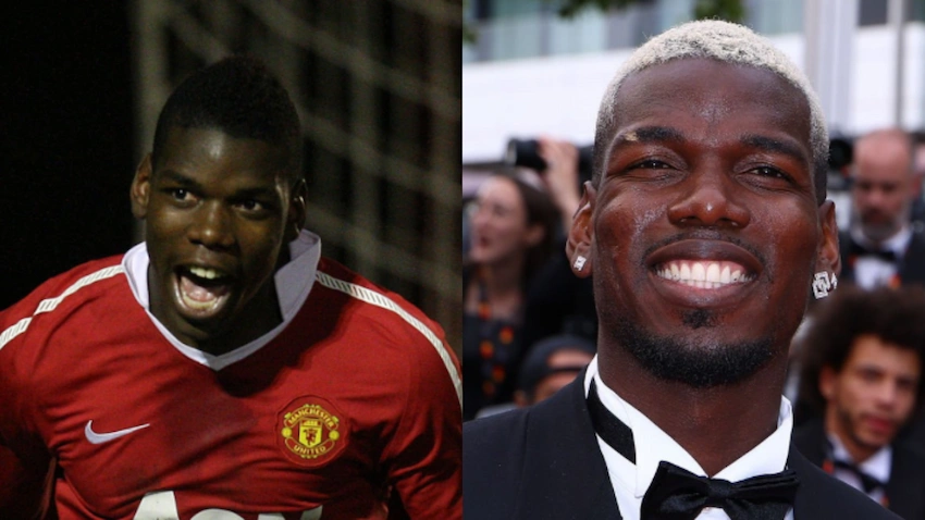 paul pogba teeth before after