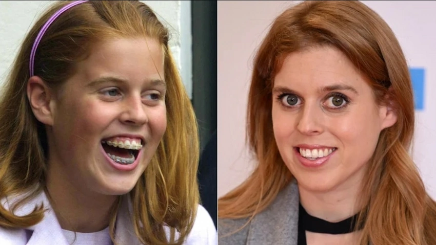 princess beatrice teeth