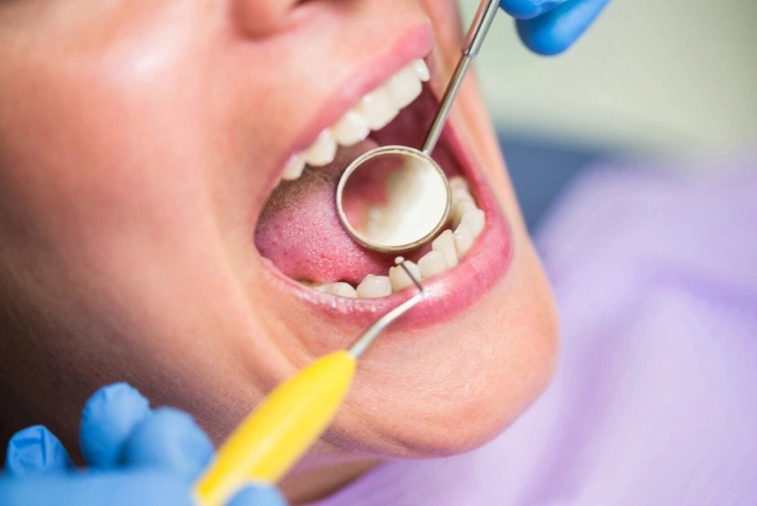 removing tartar