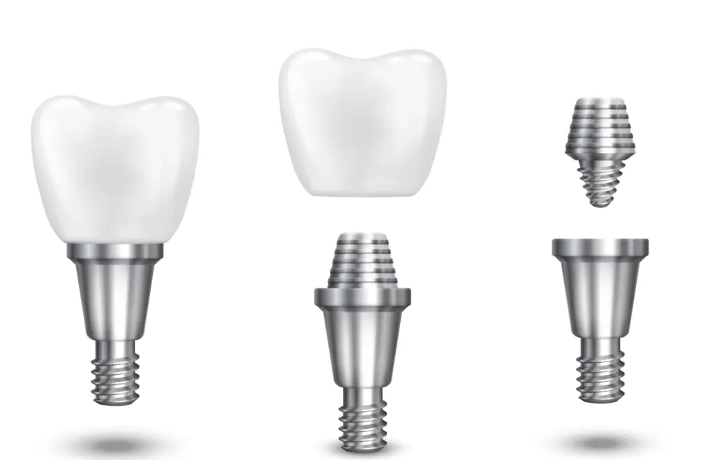 screwless dental implants