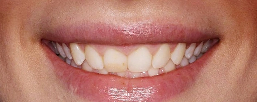 tilting inward teeth
