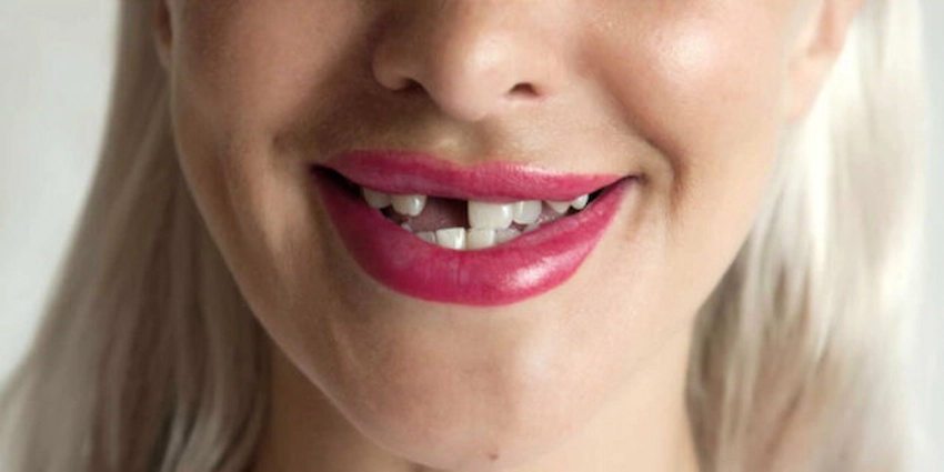 tooth loss