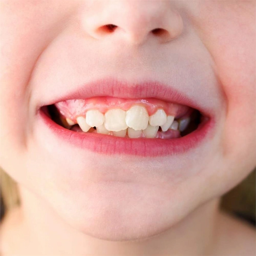 what are crooked teeth