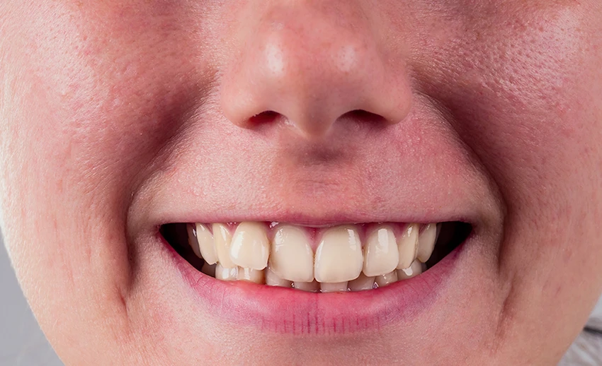 what are the causes of crooked teeth