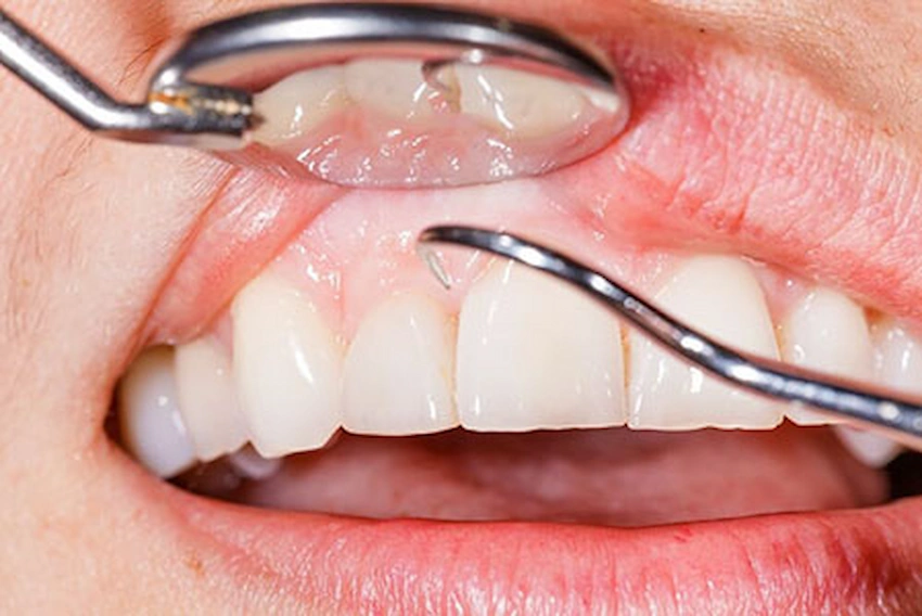what are the risk factors for tooth loss