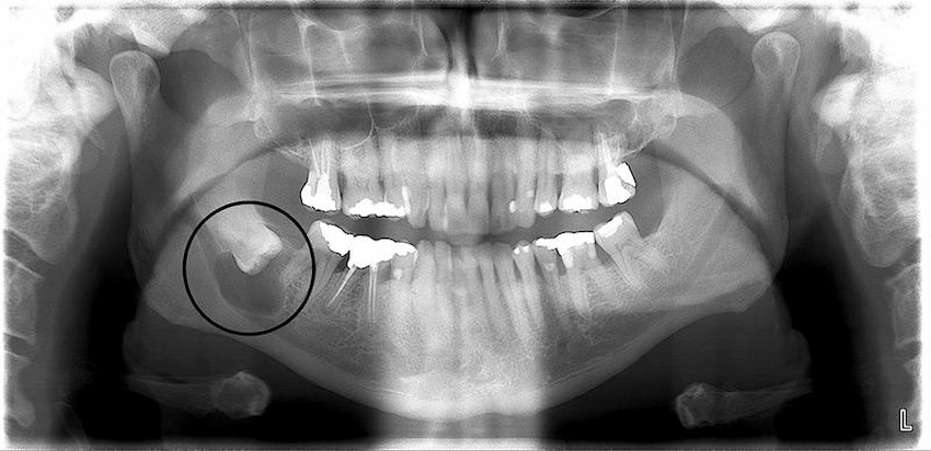 what is dental cyst
