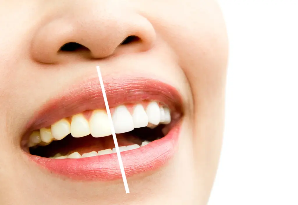 whiten teeth