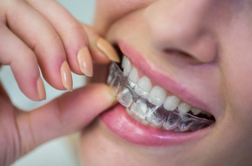 woman wearing silicone invisible braces