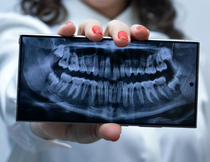 x ray of teeth