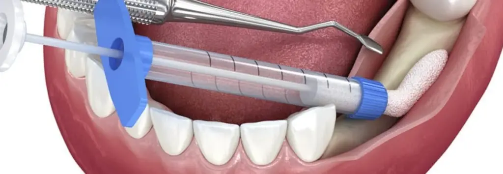D7250 Dental Code: Impacted Tooth Removal and Bone Grafting | LEMA