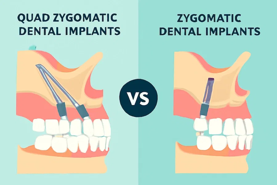quad zygomatic dental implants vs zygomatic dental implants