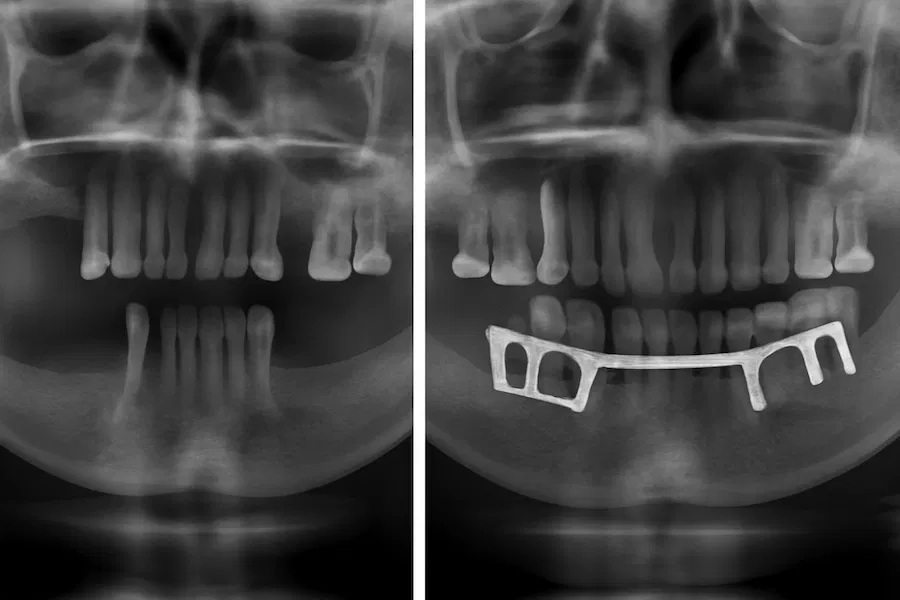 xray endosteal and subperiosteal implants