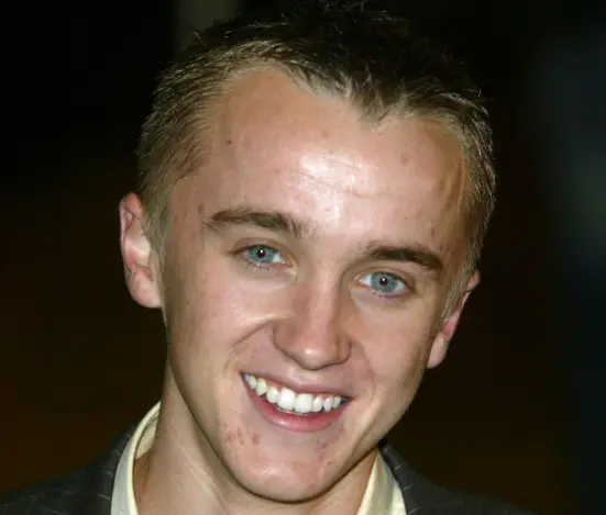 tom-felton-teeth-in-2005