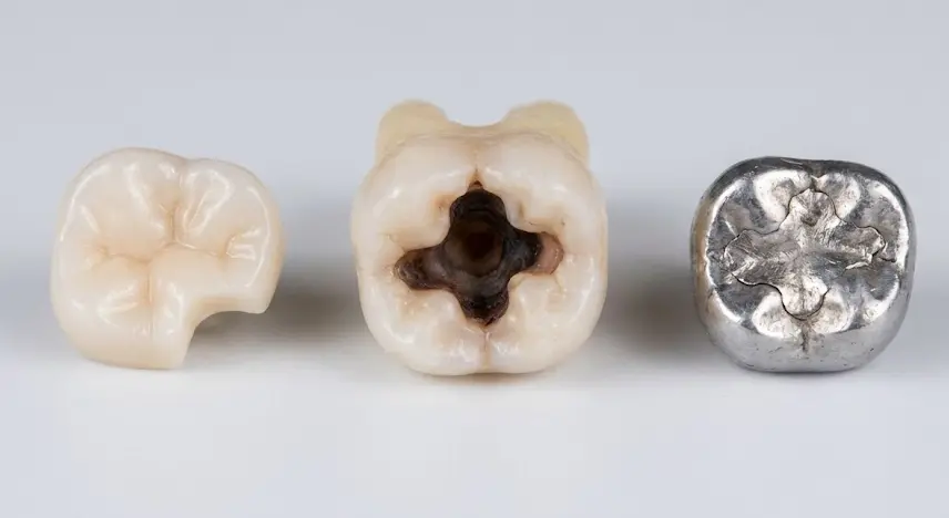 inlay vs fillings