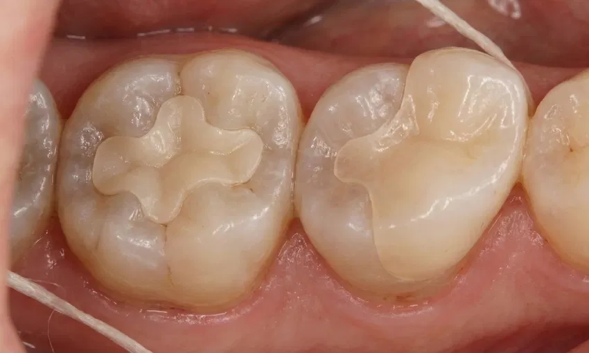 What Are Inlays and Onlays? | LEMA