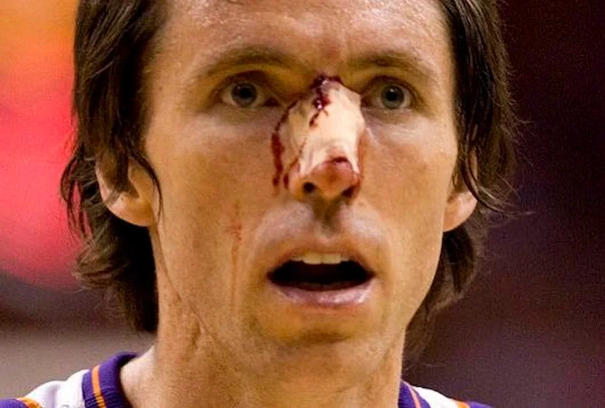 steve nash teeth 2007 1