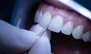 how to fix bulky or overly white veneers