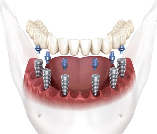 Cost Of Full Dental Implants Explained