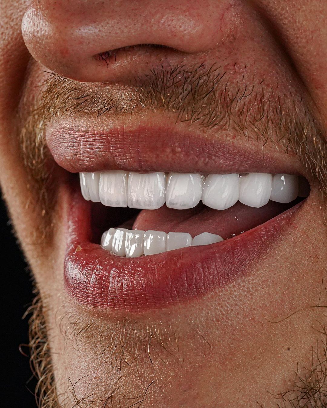 All on 4 implantul dentar