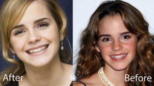 Emma Watson zähne vor ihren 