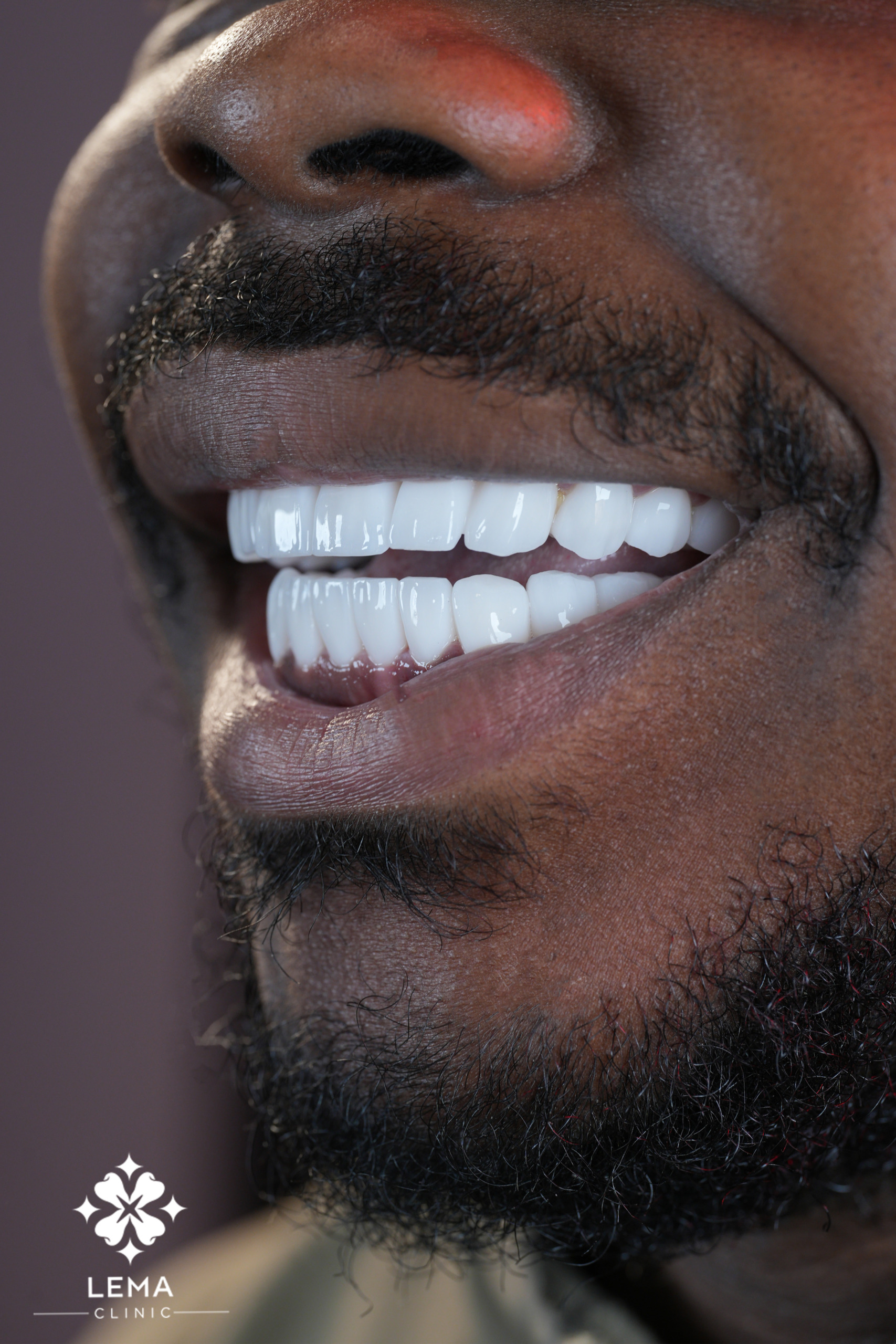 Ottenere Impianto Dentale