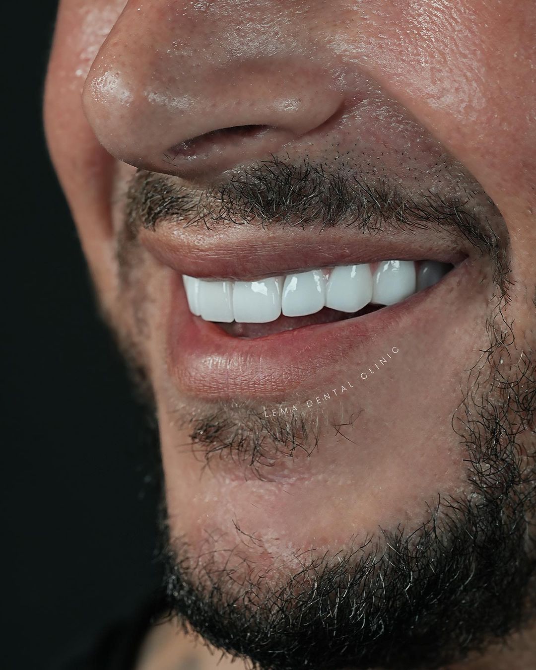 Tratamientos carillas dentales Emax