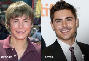Zac Efron dişleri öncesi
