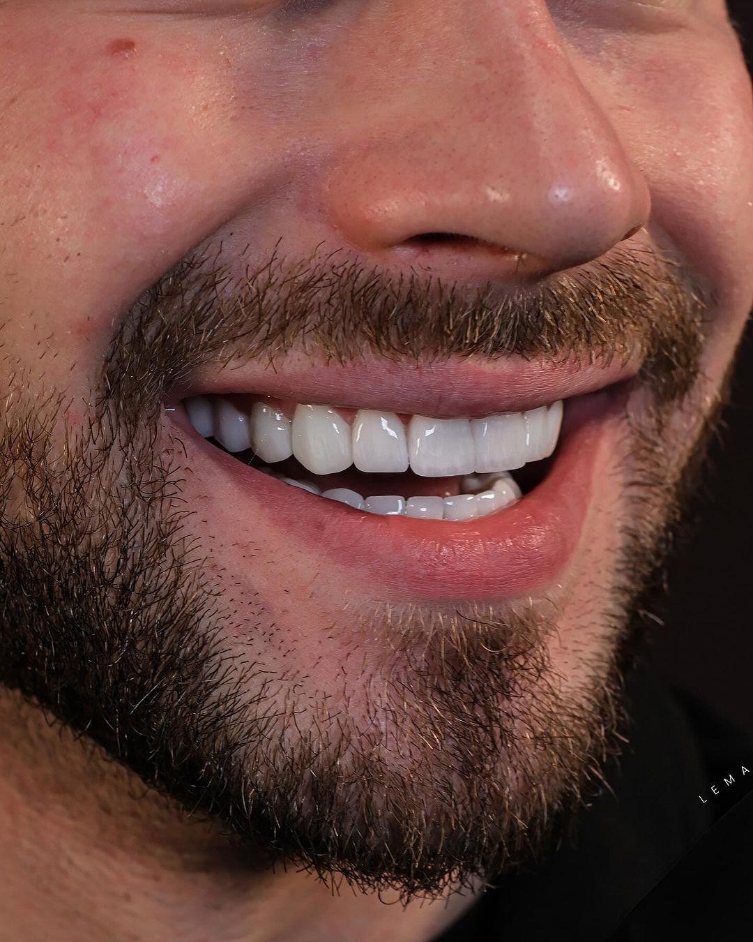 carillas dentales emax costo