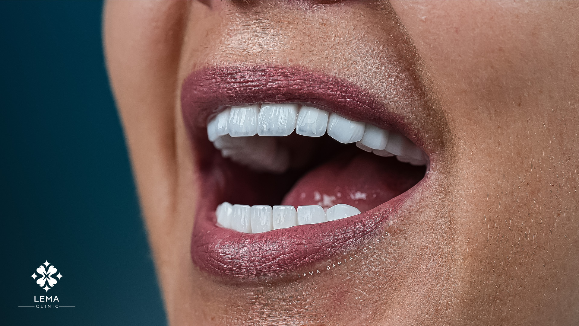 causes stades et prevention des maladies desgencives