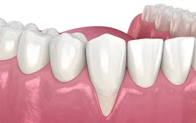 How To Fix Receding Gums Naturally