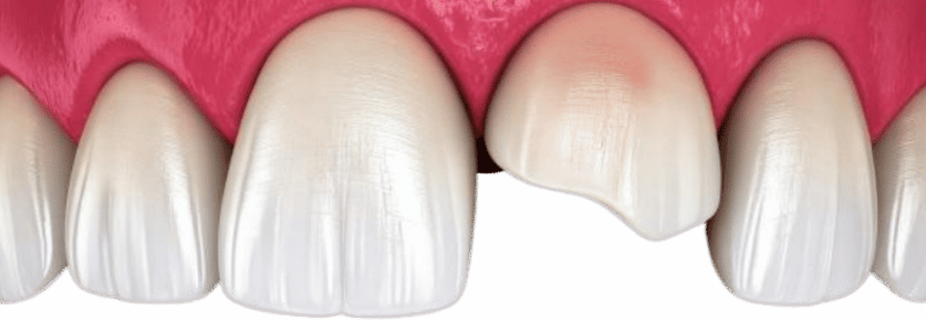 What is Cracked Tooth