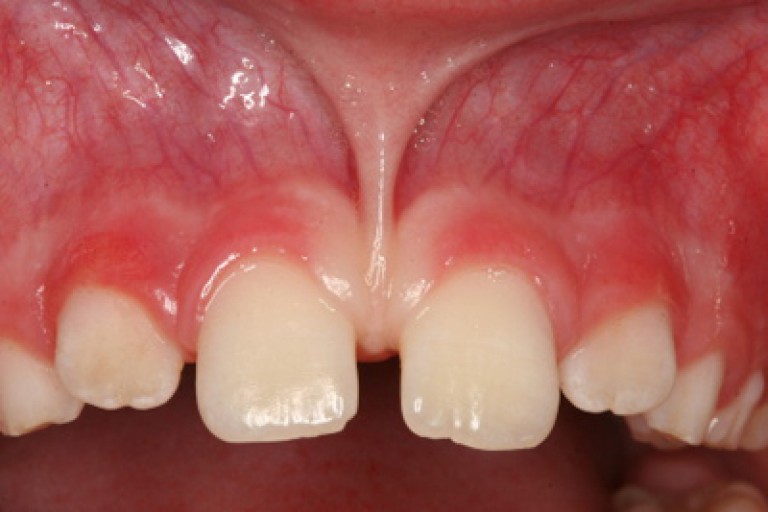 frenulum-ne-demek
