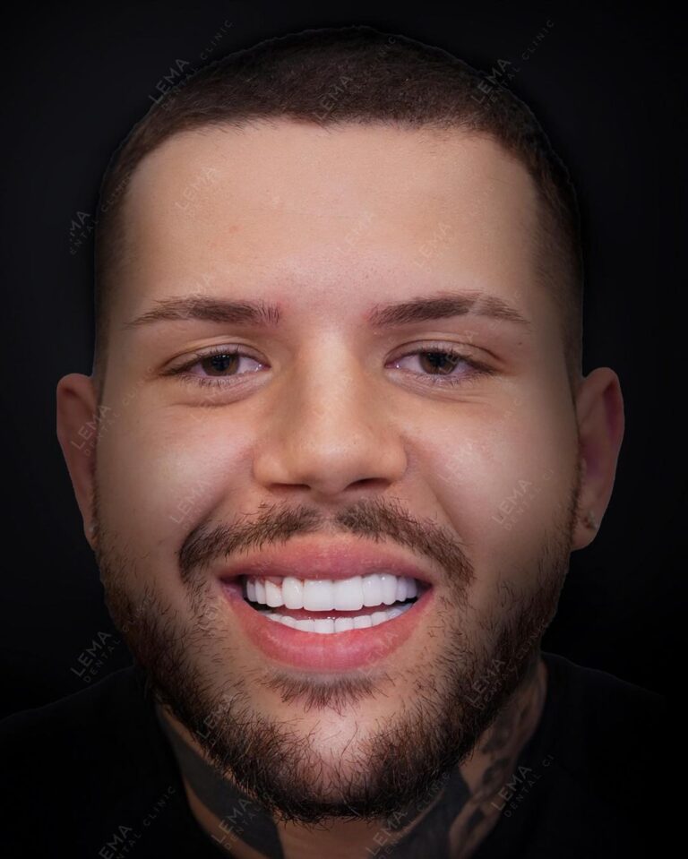 hollywood lacheln