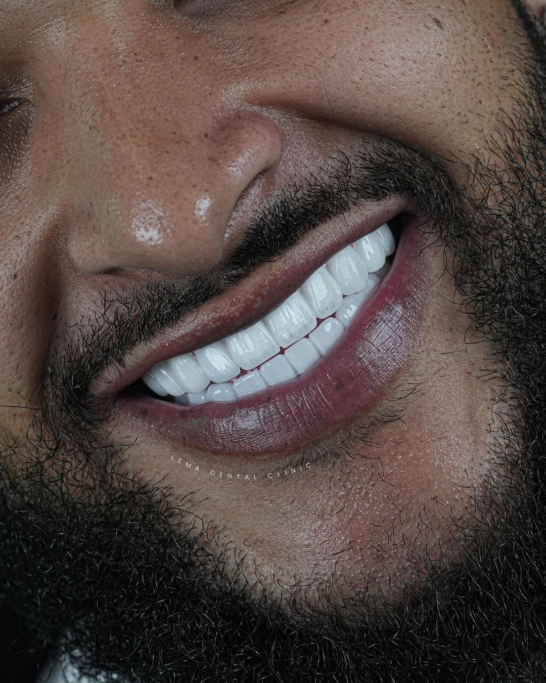 Impianto dentale