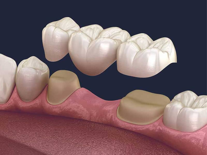 Dental Crown Procedure: A Step-By-Step Guide