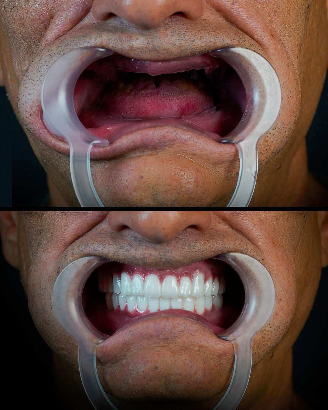 longevità impianto dentale