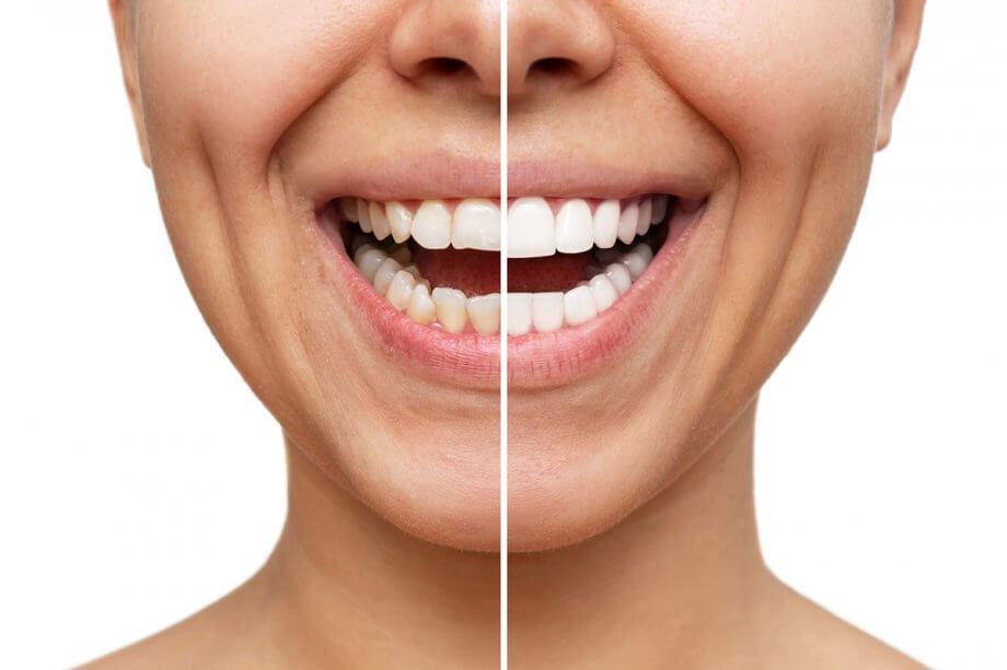 veneers-before-and-after