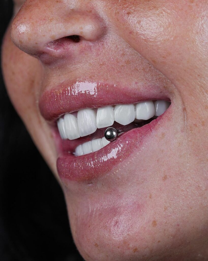 Zahnveneers Typ